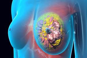 актуальные вопросы диагностики и фармакотерапии опухолевых заболеваний молочной железы