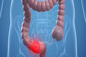 актуальные вопросы диагностики и лечения опухолевых заболеваний толстой кишки