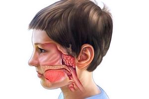 актуальные вопросы диагностики и лечения рака носоглотки у детей