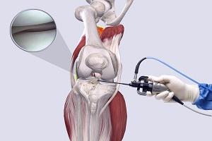 актуальные вопросы травматологии и ортопедии. лечебная артроскопия коленного сустава